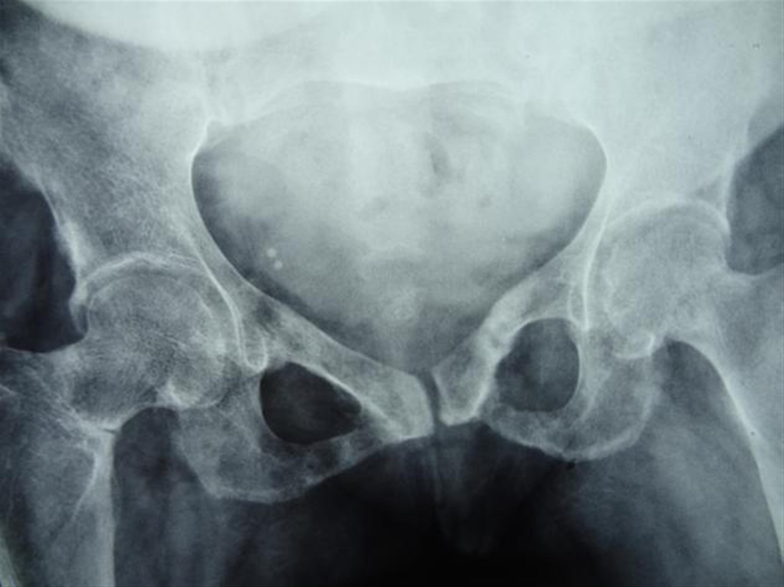 Osteomalacia Radiology